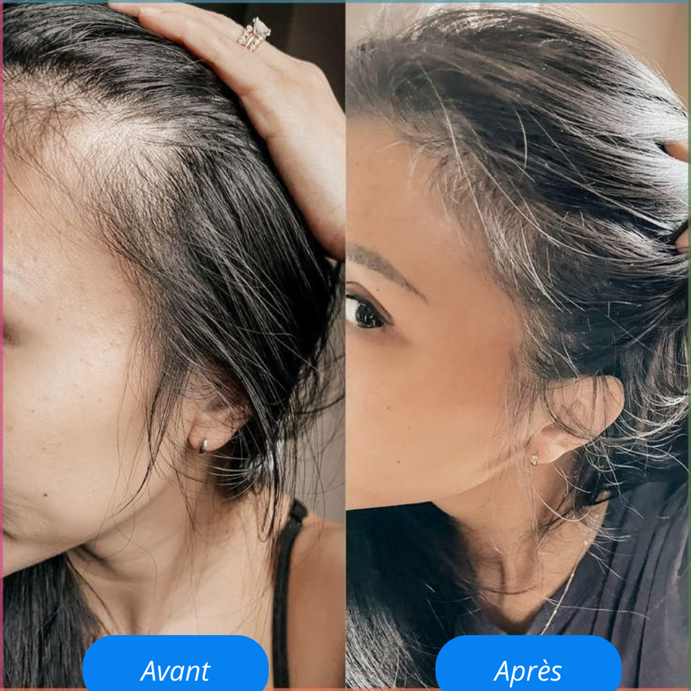 Revoria© Sérum Capillaire – Stimule la Pousse & Renforce les Cheveux